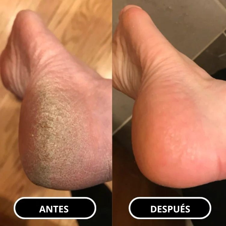 Barra para cuidado de pies  Alheya
